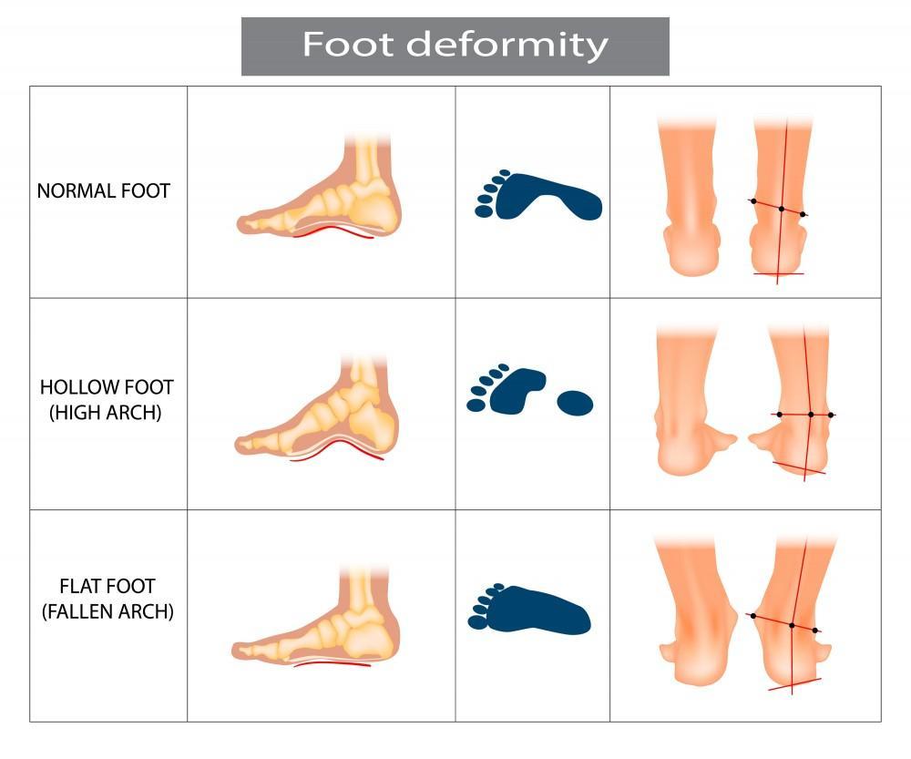 Walk with Confidence: The Benefits of Flat Feet Correcting Orthopedic Slippers